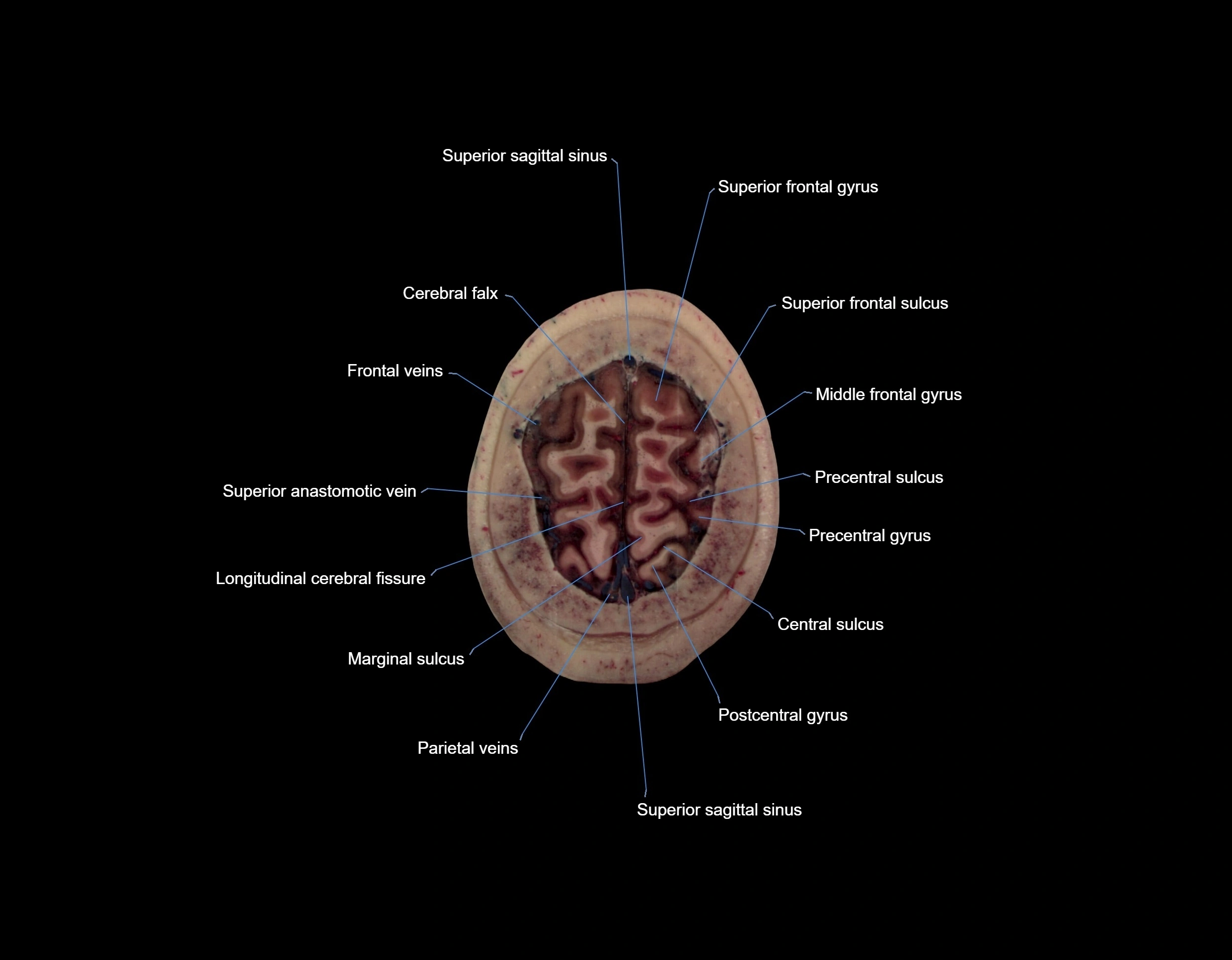MRI Brain axial cross sectional radiology anatomy 3T image  -img-000071.webp